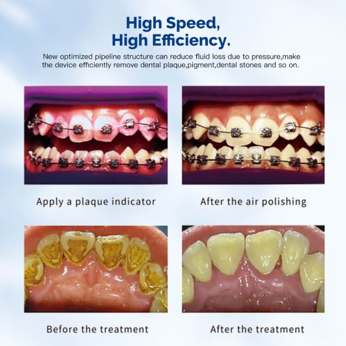 Dental VRN-DQ40 Ultrasonic Scaler Air Polisher Sandblasting Periodontal Therapy System LED Handpiece - Image 8