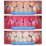 Dental Air Polisher Prophy Teeth Whitening A1S Detachable 360° Rotating Handpiece With 4 Holes Quick Coupler - Image 12