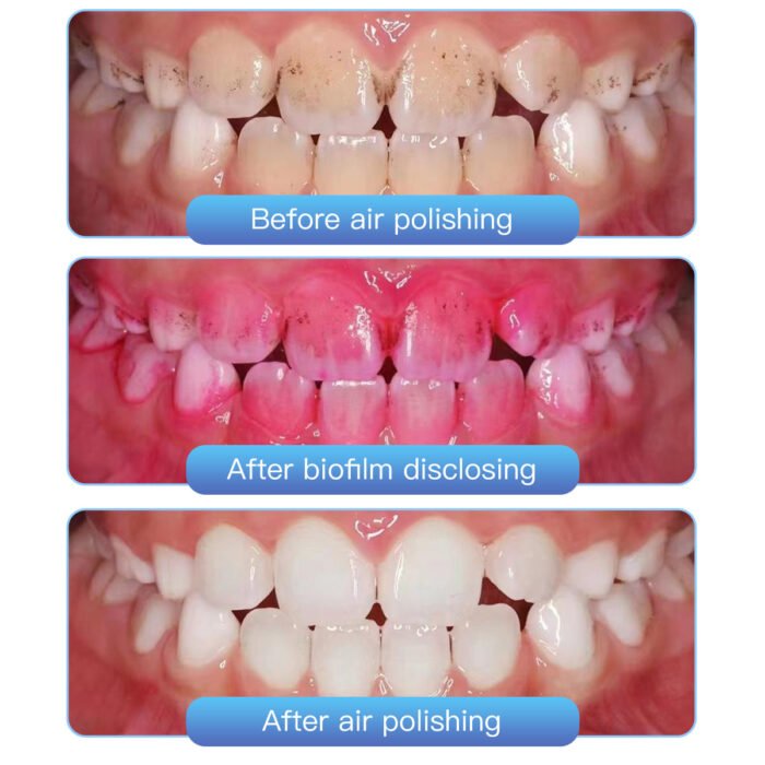 Dental Air Polisher Prophy Teeth Whitening A1S Detachable 360° Rotating Handpiece With 4 Holes Quick Coupler - Image 12